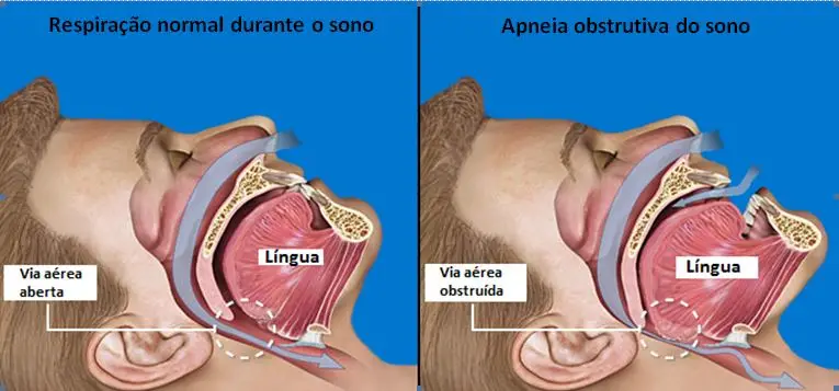 AOS